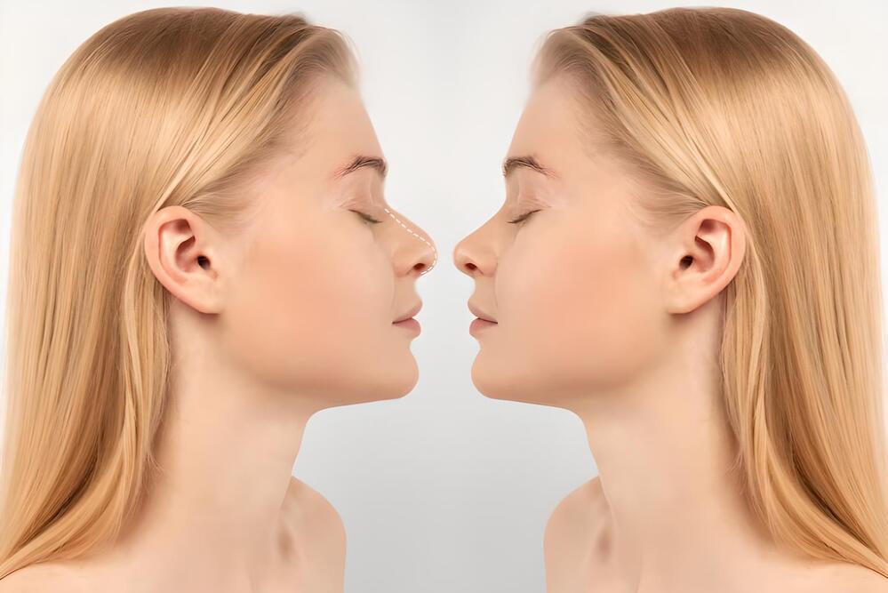 mujer rubia modo espejo cirugía nariz