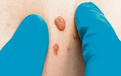 Lesiones cutáneas benignas, como eliminarlas