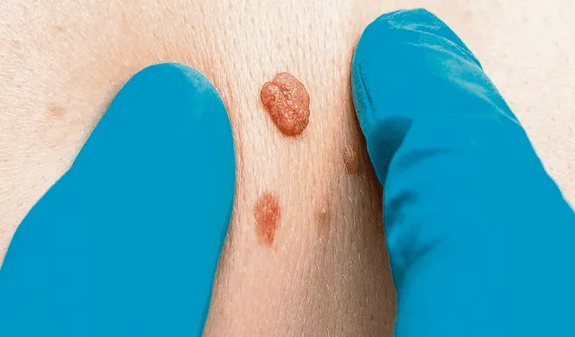 lesion-cutanea-beningna