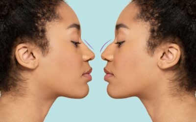Rinoplastia secundaria: cómo abordar correcciones después de una primera cirugía no satisfactoria