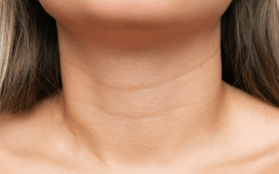 Cirugía del cuello: lifting o liposucción